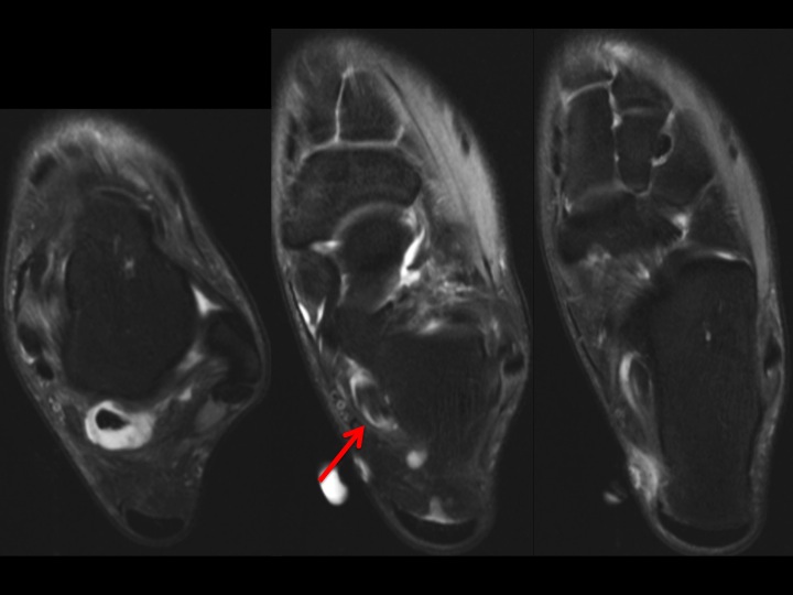 Figure 3 for case FHL partial tear and tenosynovitis